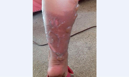 Criança teve a perna queimada por água quente jogada por colega em sala de aula em Vitória da Conquista (Foto: Arquivo Pessoal / Paulo César)
